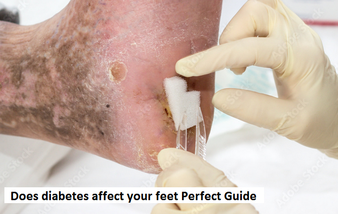 Does diabetes affect your feet? Perfect Guide